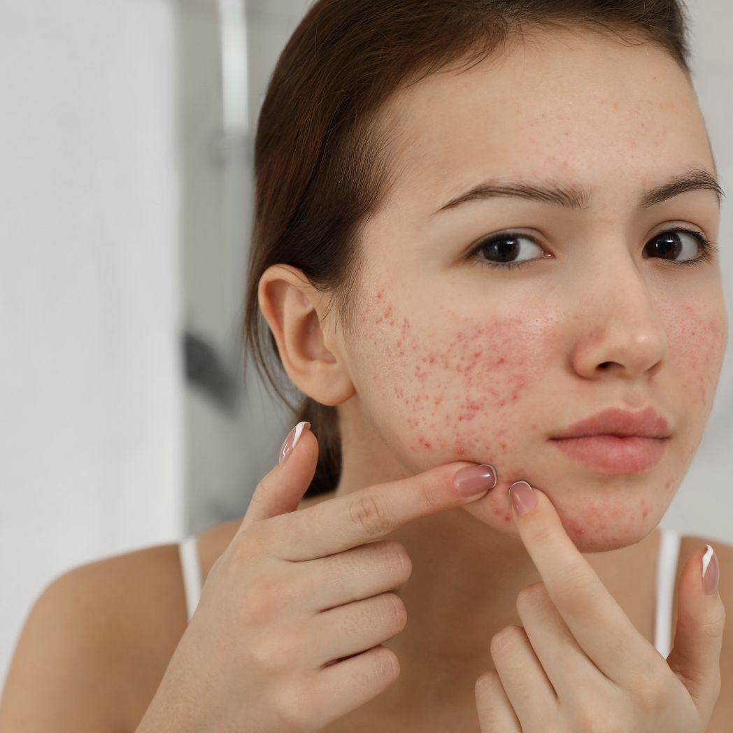 Rashes like eczema, acne or rosacea