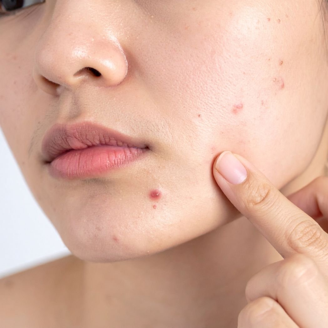 Close-up of facial skin flare-ups and acne irritation associated with immune dysregulation symptoms.